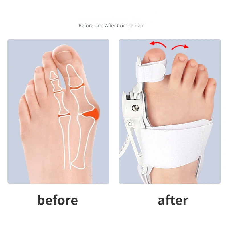 Hallux Valgus Corrector – Toe Separator & Bunion Aligner